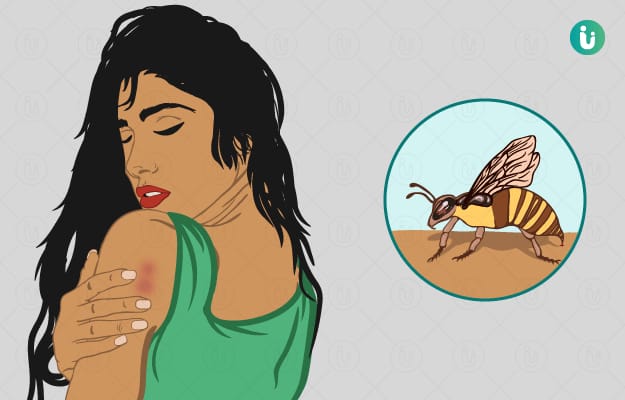 A couple was seriously injured in a bee attack in Belkappi village. They were referred